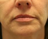 Feel Beautiful - Filler Gel for Smile Lines Around Lips - Before Photo